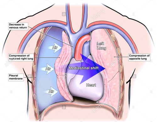 Pneumothorax sous tension : déplacement médiastinal Schéma d’un pneumothorax sous tension avec déplacement médiastinal et baisse du retour veineux